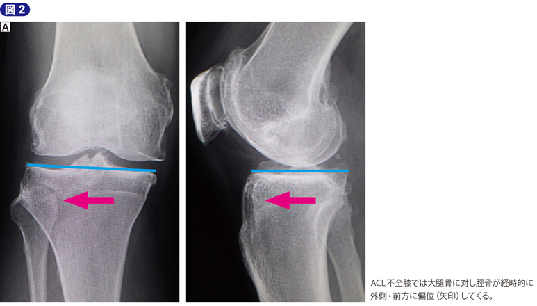 膝周囲骨切り術（AKO）｜書籍・jmedmook|日本医事新報社
